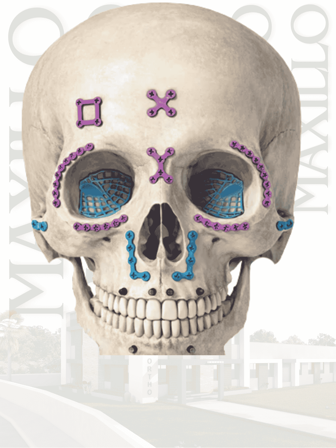 Maxillo implant and specification presentation