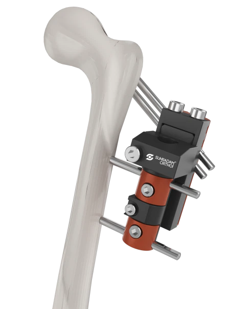 Pertrochanteric Fixator product image
